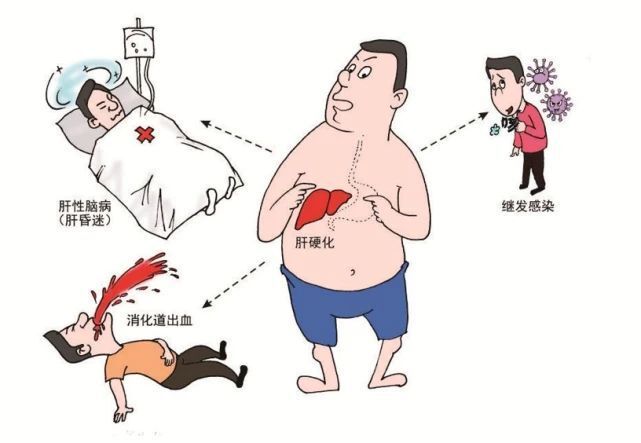 肝硬化严重程度如何判断?一文教你如何辨别!