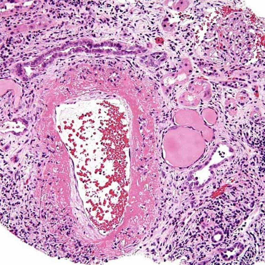 中动脉纤维蛋白样坏死结节性多动脉炎(pan)肾活检表现为环状,跨壁纤维