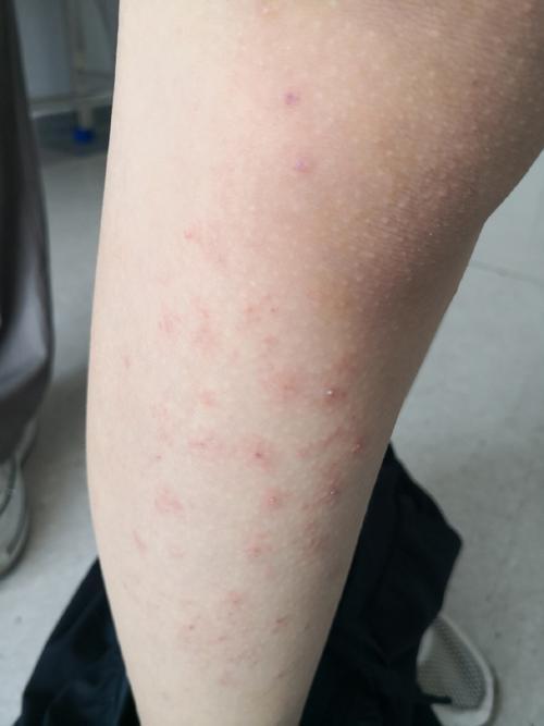 科普日历 | 炎炎夏日,"过敏星人"怎么办?