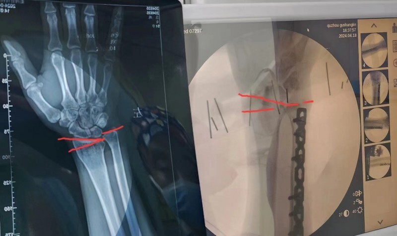 十多年手腕疼痛终于解决！衢州骨伤科医院腕关节镜微创手术，患者一天出院