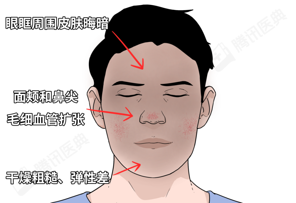 因为肝有问题,很容易出现特有的肝病面容