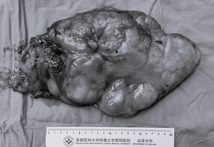 【朝医新闻】泌尿外科实施机器人辅助下腹膜后巨大肉瘤切除术