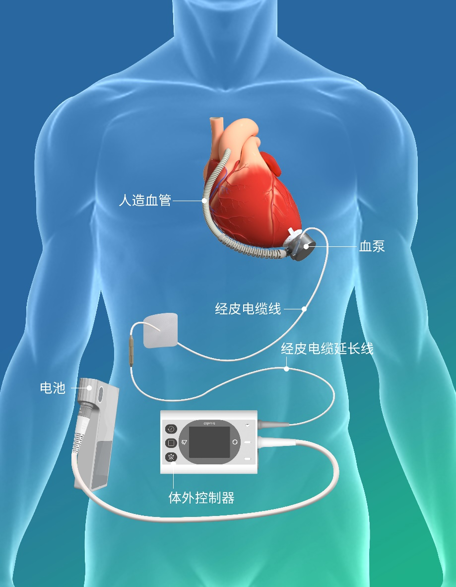 国产人工心脏,ide申请获fda批准