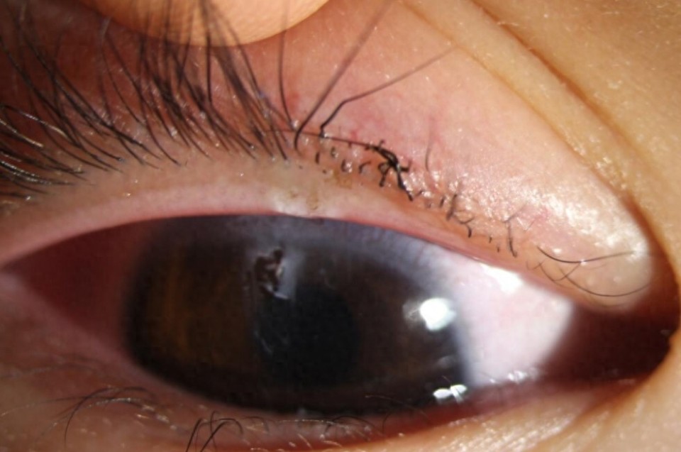 专家警示:节日期间需加强儿童眼部安全