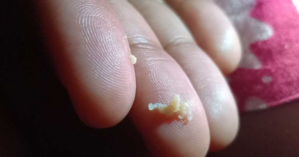 包皮口或者透过包皮可看到内部有白色的颗粒或者泥块状物.