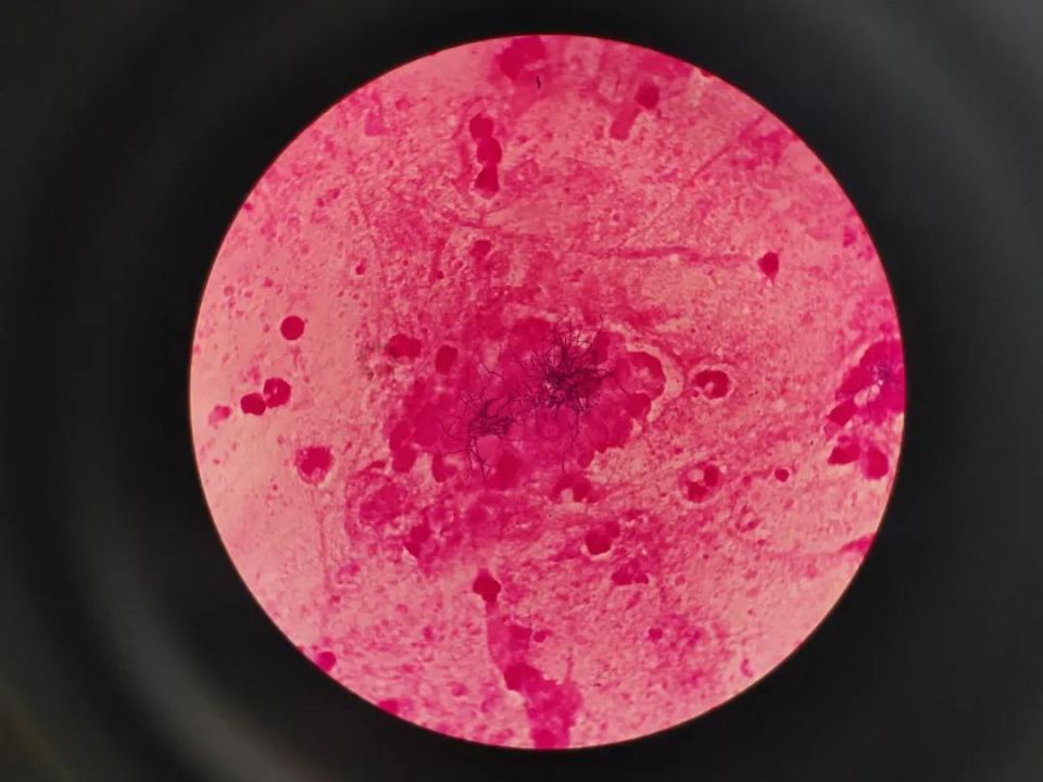 痰液抗酸染色图片