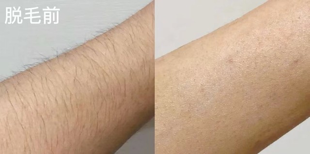 脱毛前后对比相较于动辄就大几千的医美脱毛,家用脱毛仪使用的效果我