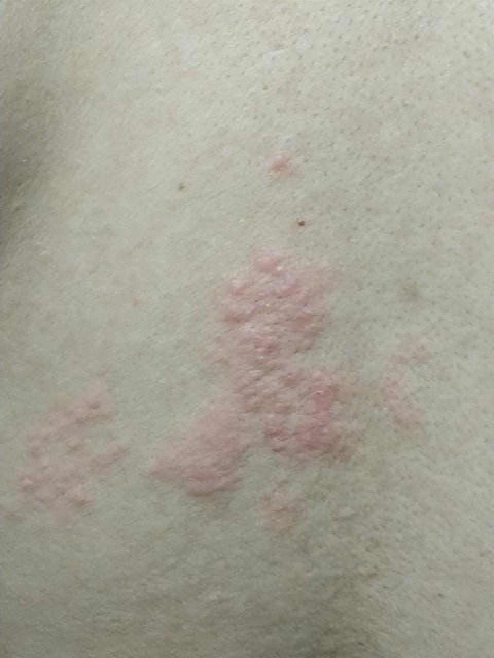 缠腰蛇?不死的癌症?带状疱疹后神经痛别再忍!治疗方法在这里_腾讯新闻