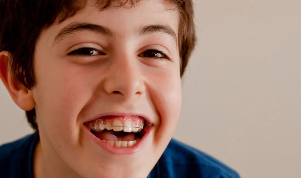 儿童青少年牙齿矫正何时为宜?几岁戴"牙套"才不算晚?_腾讯新闻
