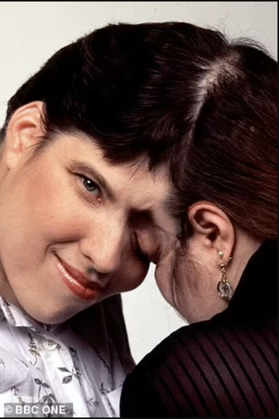 世界上最年长连体双胞胎在美国一同去世享年62岁共享大脑