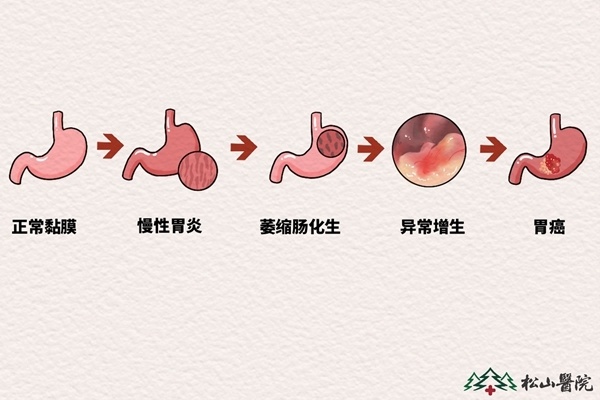 萎缩性胃炎如何"逆转"?松山医院:根除幽门杆菌是关键