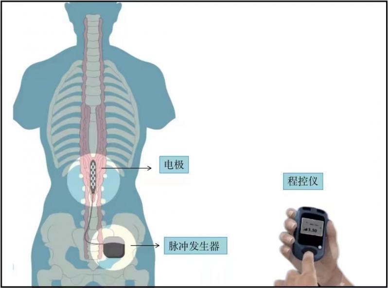 清华一附院麻醉科成功完成院内首例可充电式脊髓电刺激器植入术