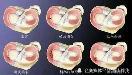 半月板損傷有什麼明顯症狀