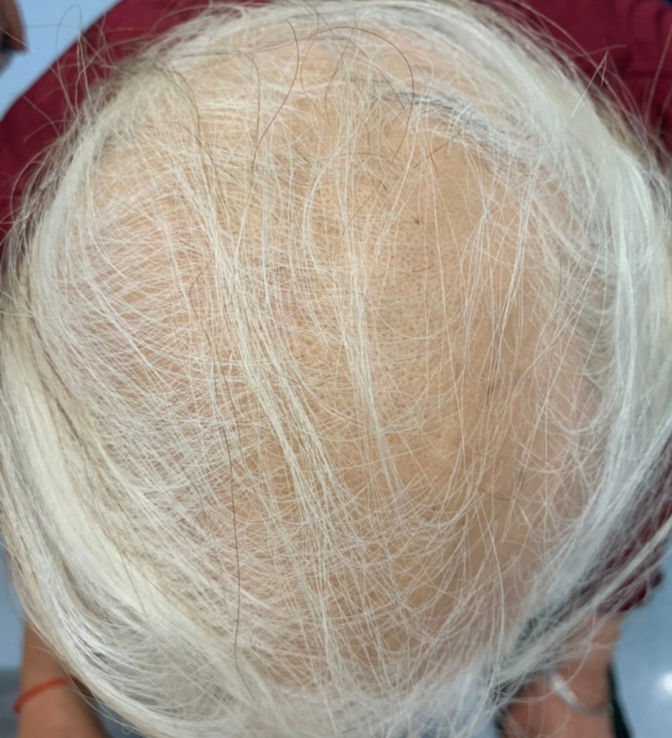 为什么现在越来越多的人出现掉发脱发甚至秃顶呢?