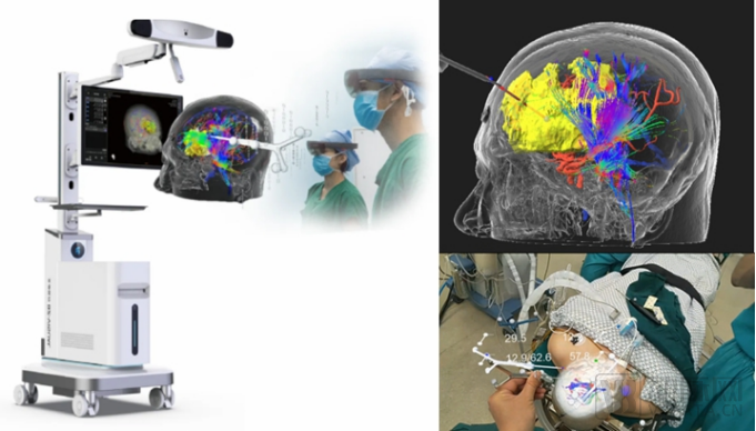 什么是等离子治疗仪北卓医疗：构筑“一体两翼”跨模态智联闭环生态，占据中国神经科学数智化浪潮先发身位_https://www.jmylbn.com_新闻资讯_第4张