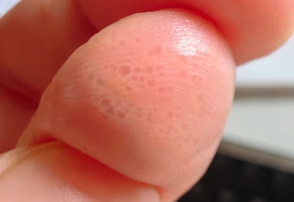 为什么一到夏天,手上就长透明小水泡