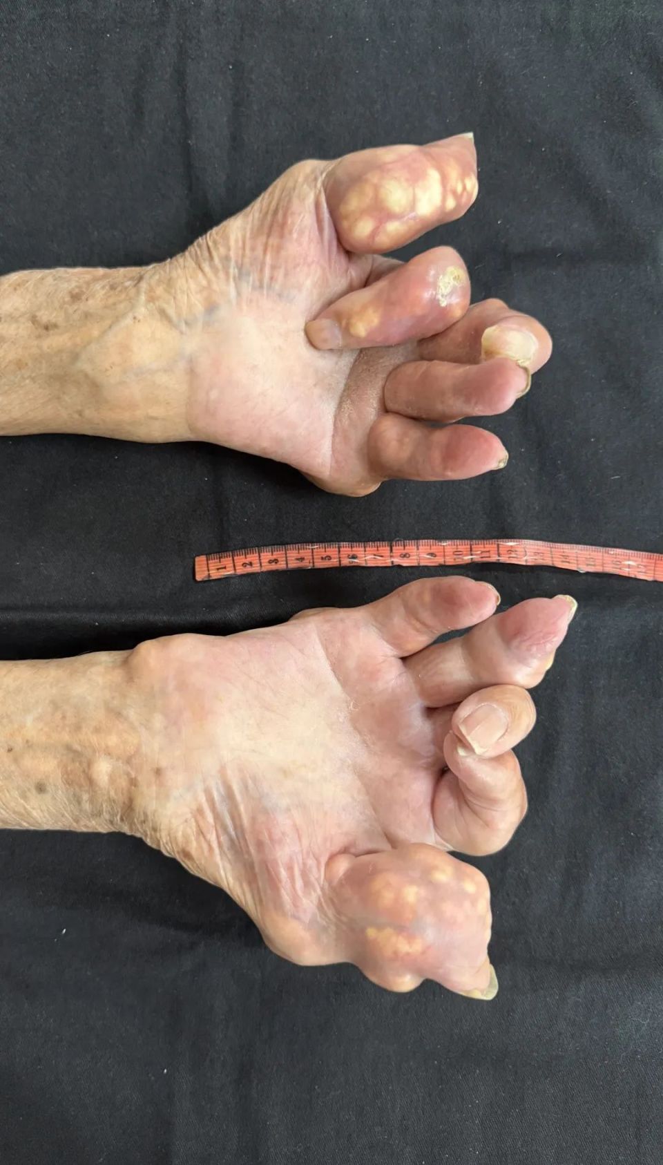 常年吃海鲜,老伯身上长满痛风石!手脚扭曲变形成"老姜" !