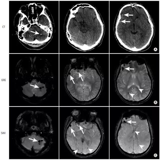 脑出血的ct表现图片图片