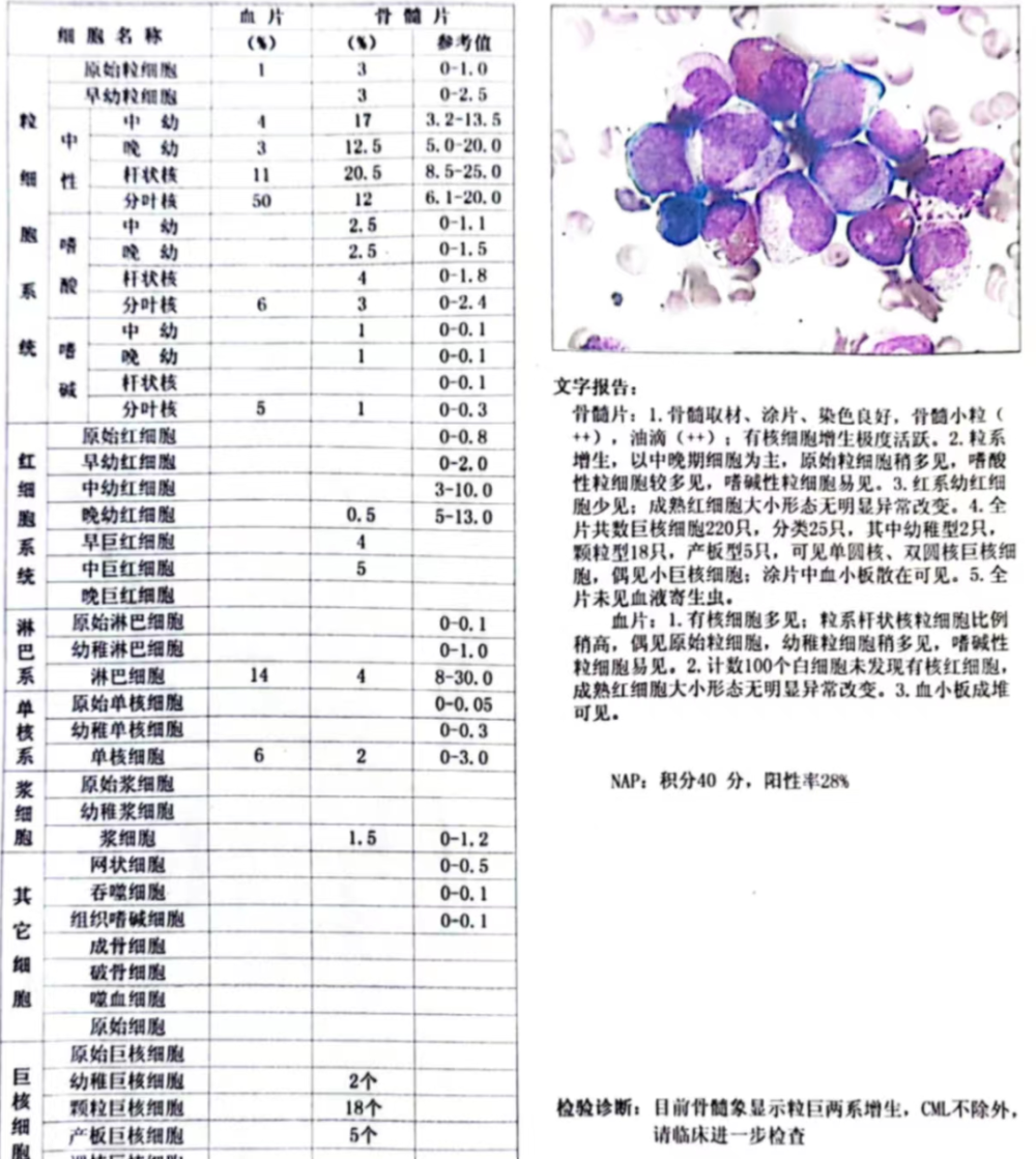 慢性粒细胞白血症图片