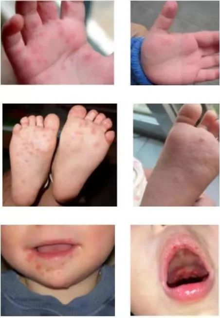 孩子哭闹,可能是得了手足口病丨贤医健康说_腾讯新闻