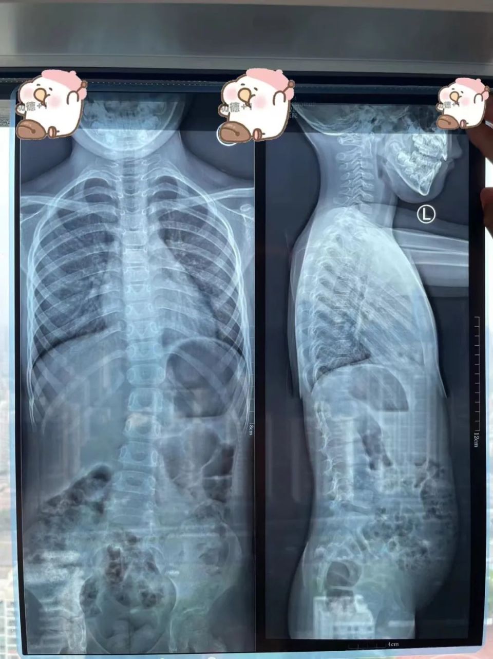 5岁孩子脊柱弯成这样,能掰直吗?教你一招给娃自测!