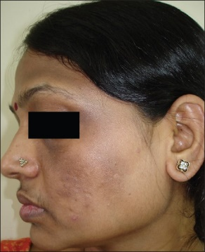 为什么别人的肥胖纹是红色我的是白色?