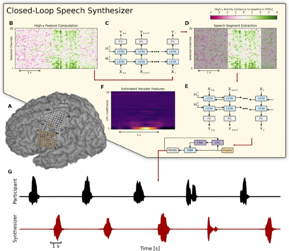 脑机接口设备预测第二位患者的内部言语加州理工学院的神经科学家们
