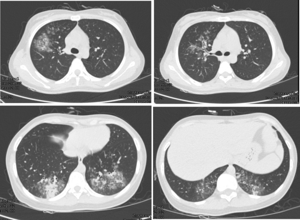 如何在肺 ct 上快速识别支原体肺炎?只需牢记这 3 个标志性特征!