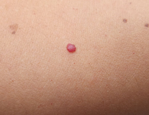 身上长红痣,是夺命"肝癌痣"?痣上长毛,说明癌细胞"已激活"?早知早好