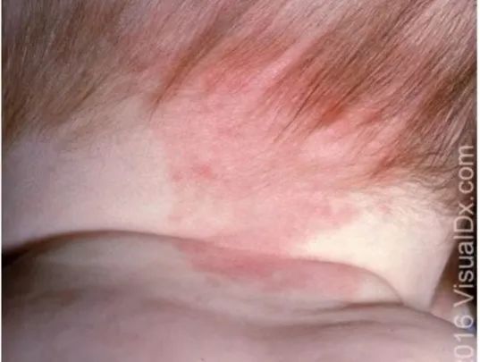 每年数以万计新生儿出现这种「红色胎记」,治疗要趁早!