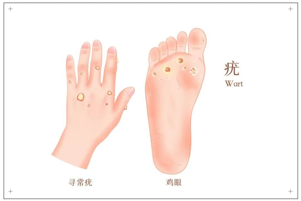 手指也会感染HPV？医生提醒这些注意事项_腾讯新闻