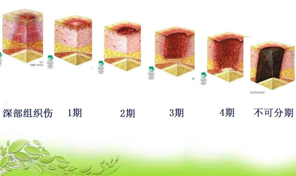 一文了解压疮的护理