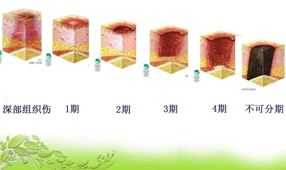 压疮皮肤分层结构图图片