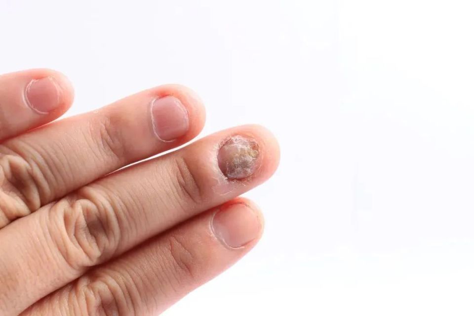 灰指甲的「克星」居然是它?很多人却不敢用