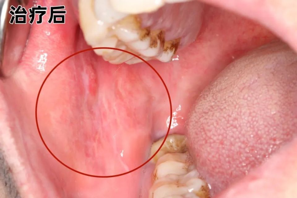活检发现存在异常增生的口腔白斑,口腔红斑,口腔扁平苔藓,以及早期且