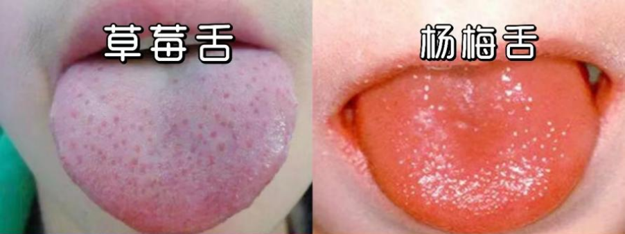 streptococcus,gas)感染引起的急性呼吸道传染病,可引起儿童扁桃体炎