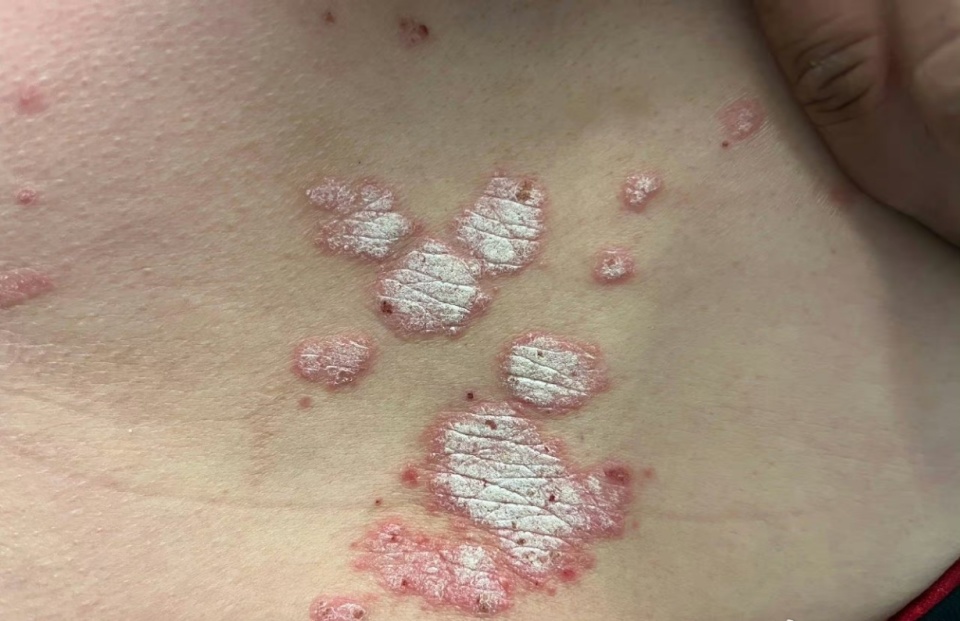 银屑病一辈子都治不好吗?