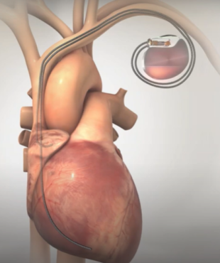 栓塞产品有哪些全球TOP10医疗器械管线布局（附表格）_https://www.jmylbn.com_新闻资讯_第15张