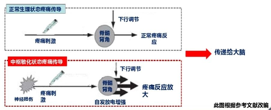 健康科普 | 如何预防急性疼痛向慢性疼痛转化?
