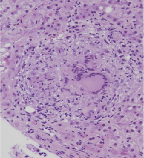 上皮样巨噬细胞的形态学特征是均质丰富的细胞浆,内无吞噬颗粒,狭长的