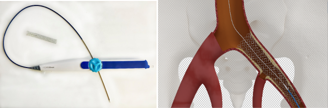 什么是创新医疗器械盘点2023获批创新医械（心血管篇）_https://www.jmylbn.com_新闻资讯_第5张