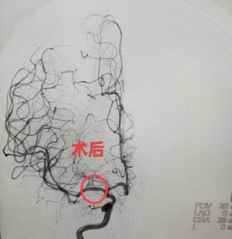 手术前后对比图如下:患者近10天内发作脑梗死2次,虽均为小梗塞,但ct
