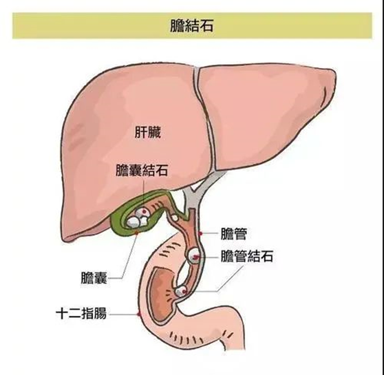 冬季胆结石"凶猛" 小石头危害大