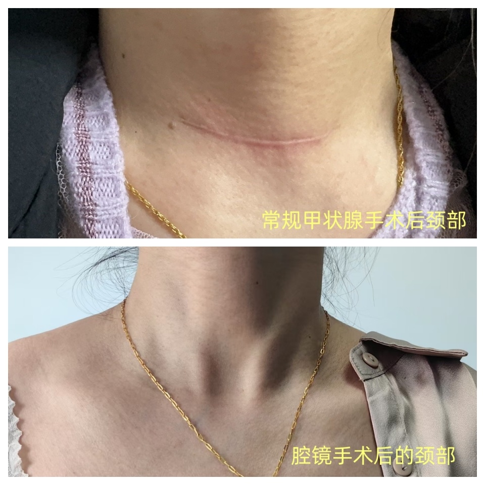 甲状旁腺肿瘤切除,甲状腺功能亢进症,数量更多的是甲状腺癌根治术