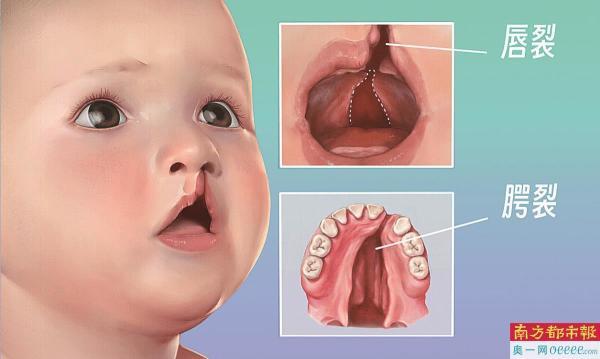 小舌头腭裂图片图片