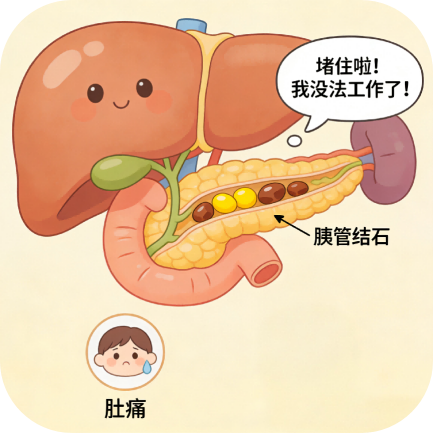 主要碎石器有什么碎碎缓腹痛——胰管结石体外震波碎石术-上海聚慕医疗器械有限公司