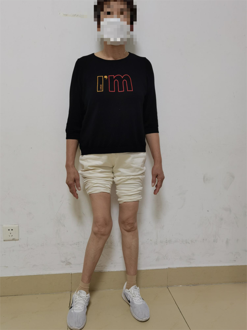 术前外观,右膝严重外翻畸形临床上重度外翻膝这种最严重的骨性关节炎