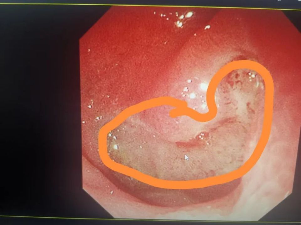 胃淋巴瘤胃镜图片