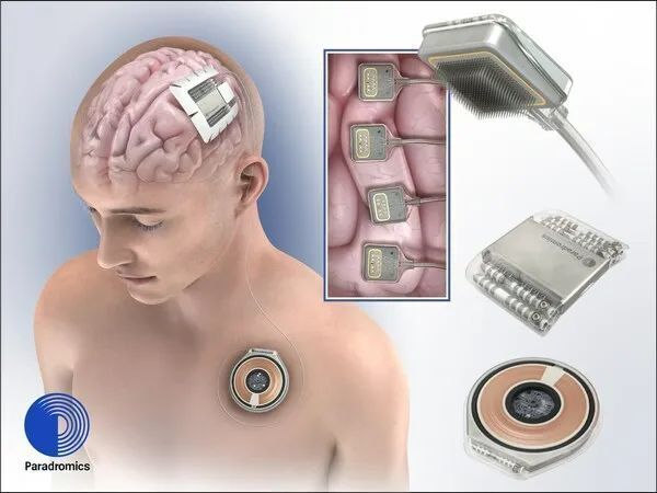 neuralink又一竞争对手通过了fda预计明年可脑机接口人体试验