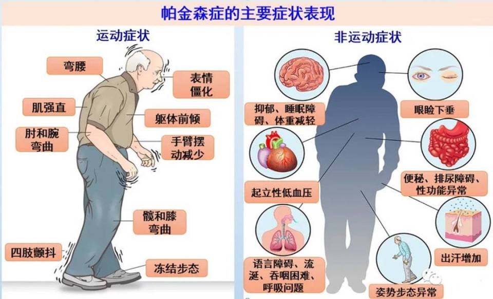 需要注意的是,这些症状并非帕金森病的特异性表现,也可能与其他疾病有